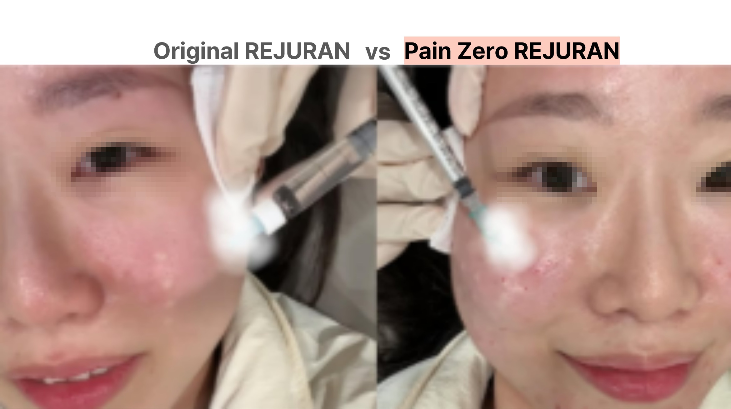 Afraid of Rejuran Pain? Pain Zero Rejuran Offers Effective Skin Repair With Minimal Discomfort
