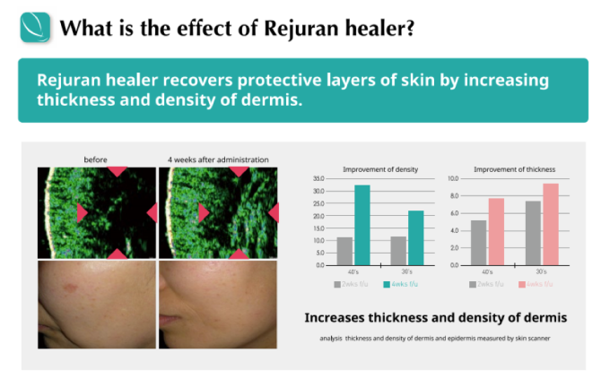 Rejuran Pain Explained: Why This Popular Skin Booster Can Hurt